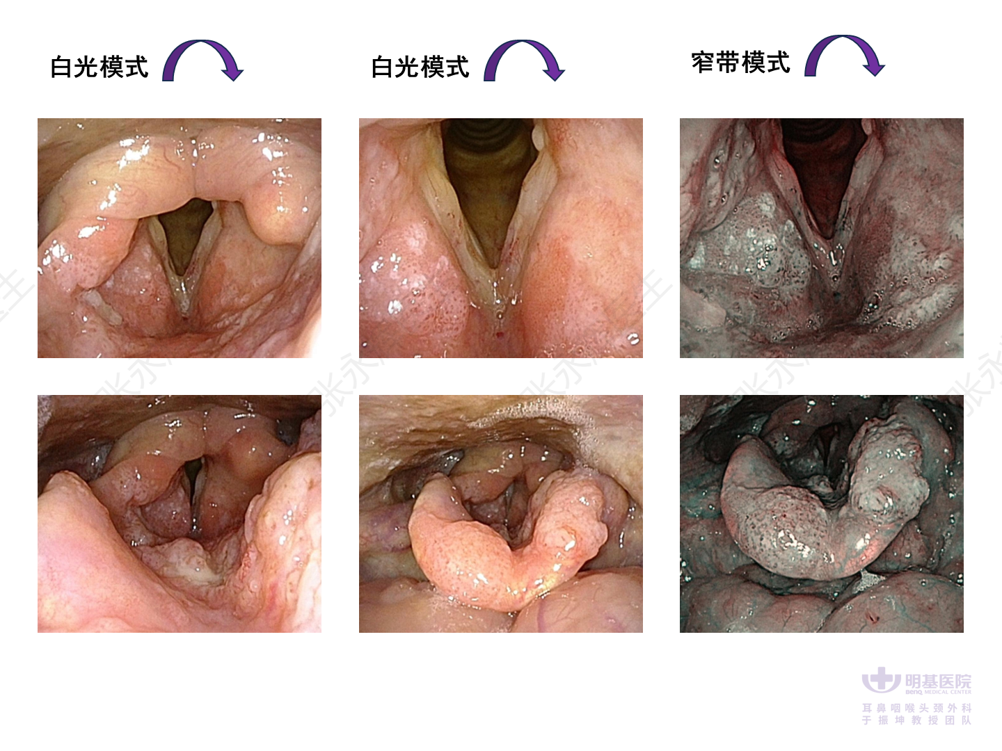 《头颈部恶性肿瘤》 (二)声门上型喉癌,见"下图"