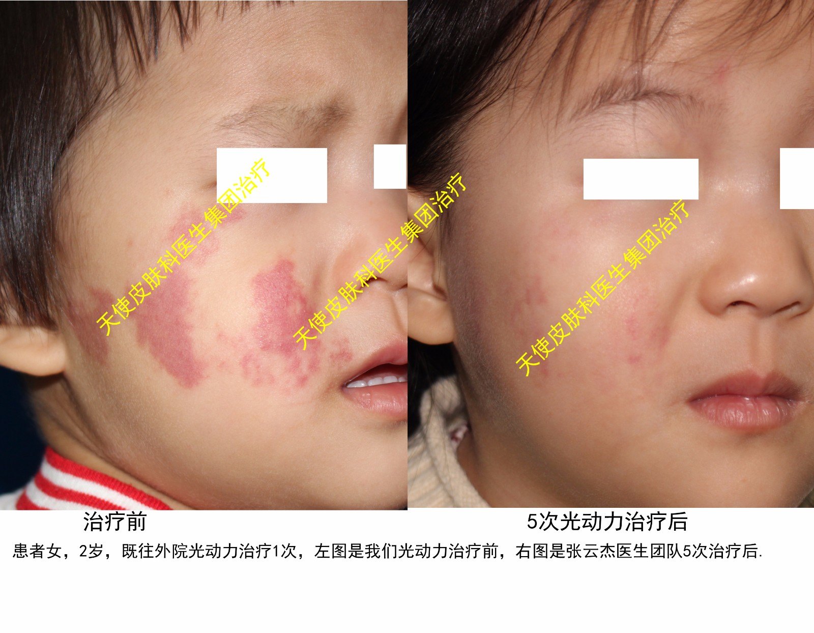 鲜红斑痣最新的治疗系统 海姆泊芬光动力治疗 国家1 1类新药 鲜红斑痣