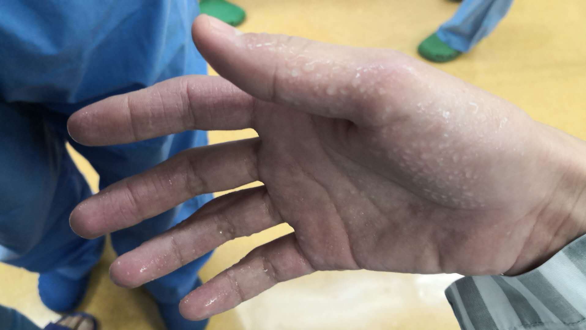 手汗症 周末24小时出入院手术(广东省人民医院胸外科)