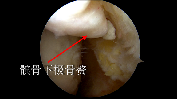 x髌骨下极骨赘.png