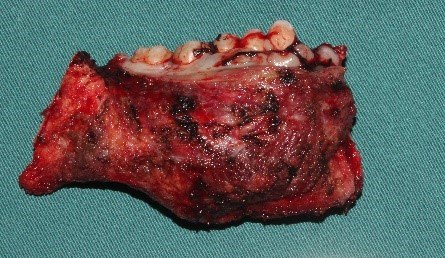 图1 下颌骨成釉细胞瘤图2 口腔癌累及下颌骨图3 a下颌骨肿瘤经口腔内