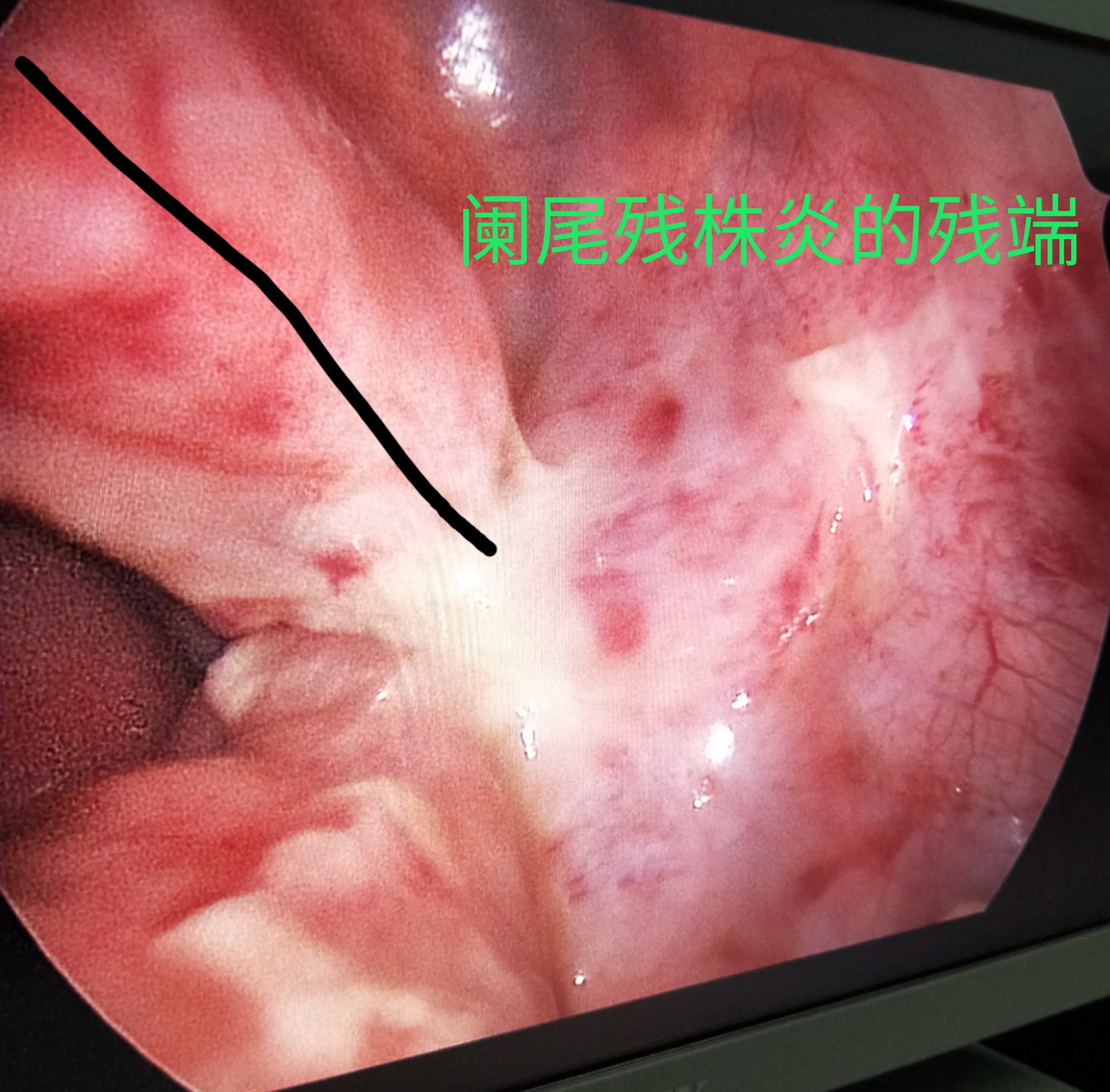 阑尾发黑图片图片