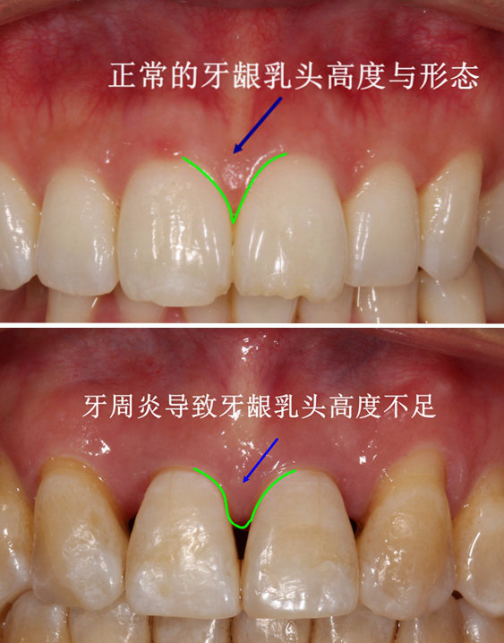 牙龈黑三角可以预防吗?怎么消除?