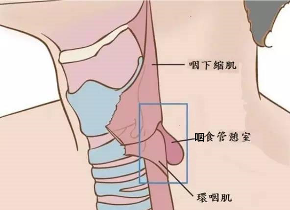 咽<!--HAODF:8:shiguanxishi-->食管憩室<!--HAODF:/8:shiguanxishi-->2_副本.jpg