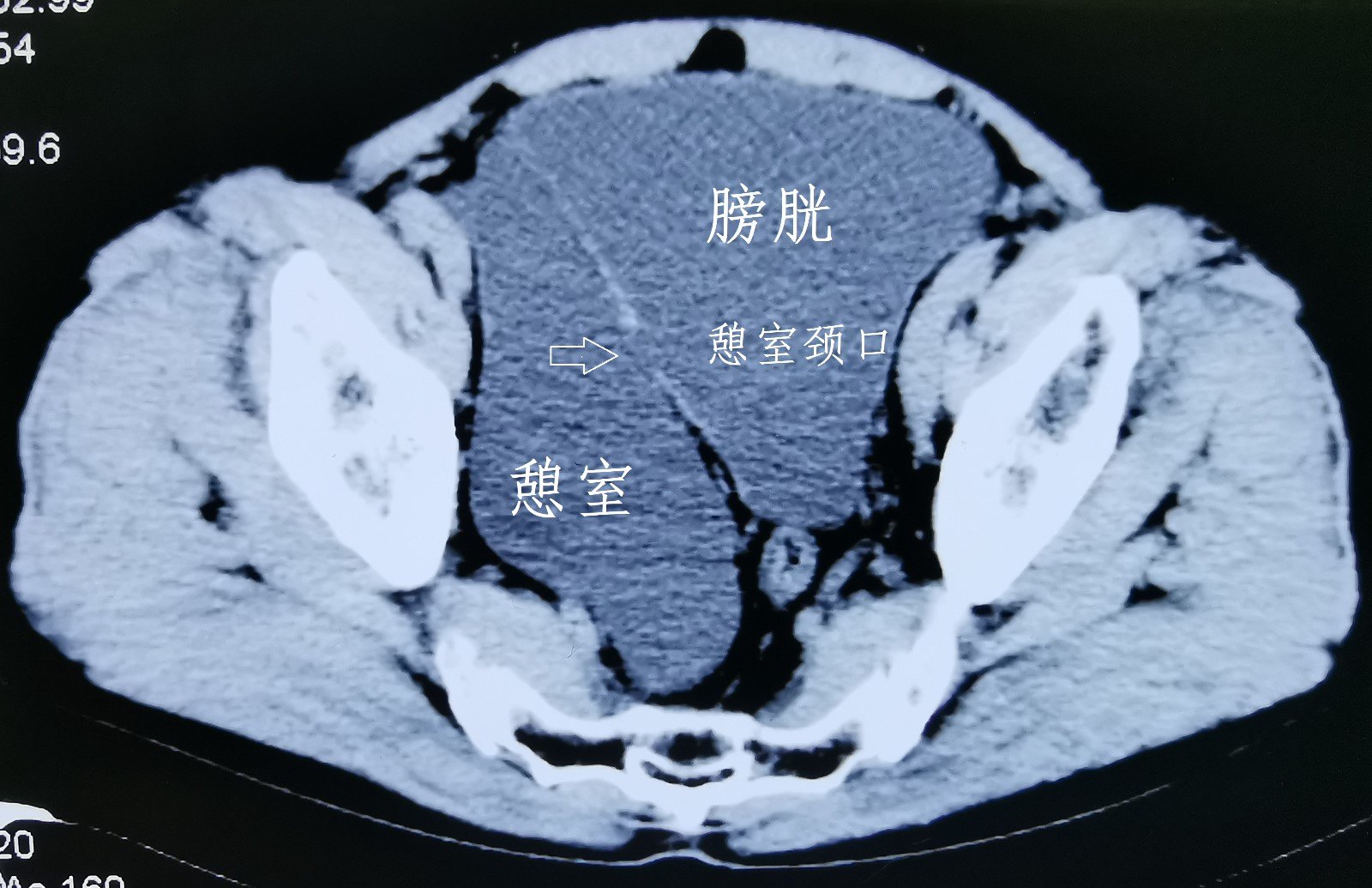 微创技术造福患友 | 我院粤赣泌尿外科团队顺利开展单孔腹腔镜肾囊肿去顶手术-广东省人民医院赣州医院（赣州市立医院）