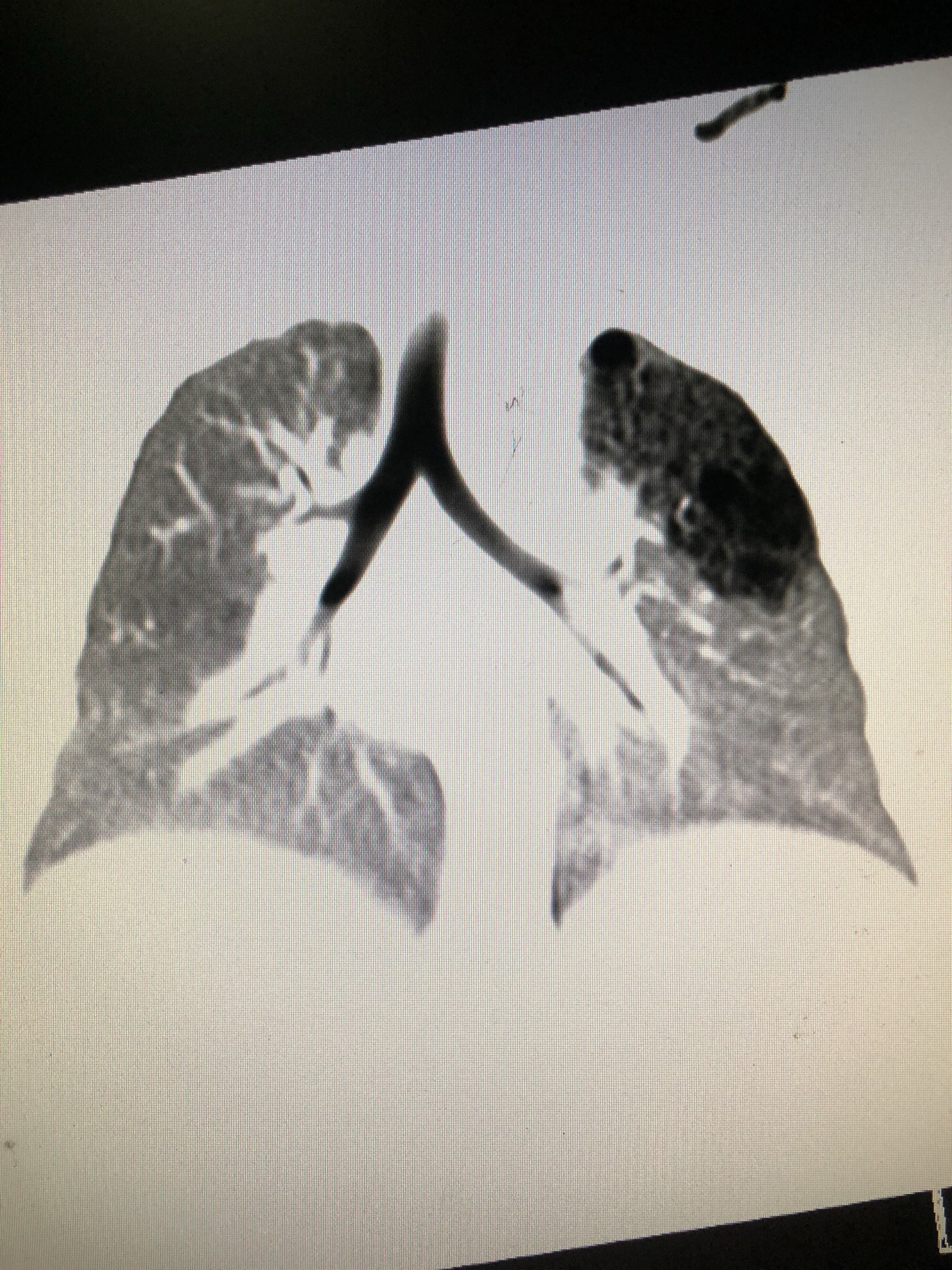 肺结节最怕三种运动一_胸膜结节比肺结节严重_肺结节手术要多久