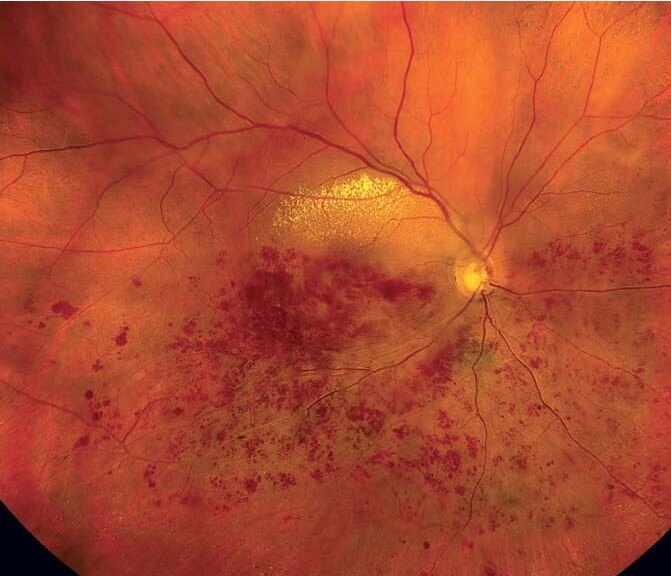 糖尿病视网膜病变眼底出血有什么症状呢?