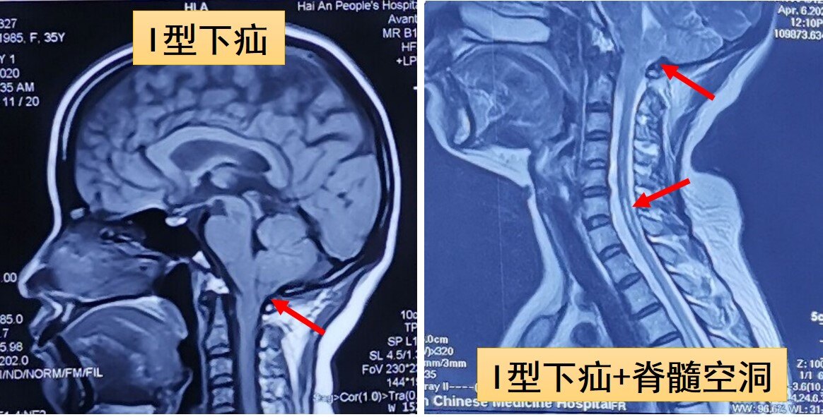 小腦扁桃體下疝是怎麼回事