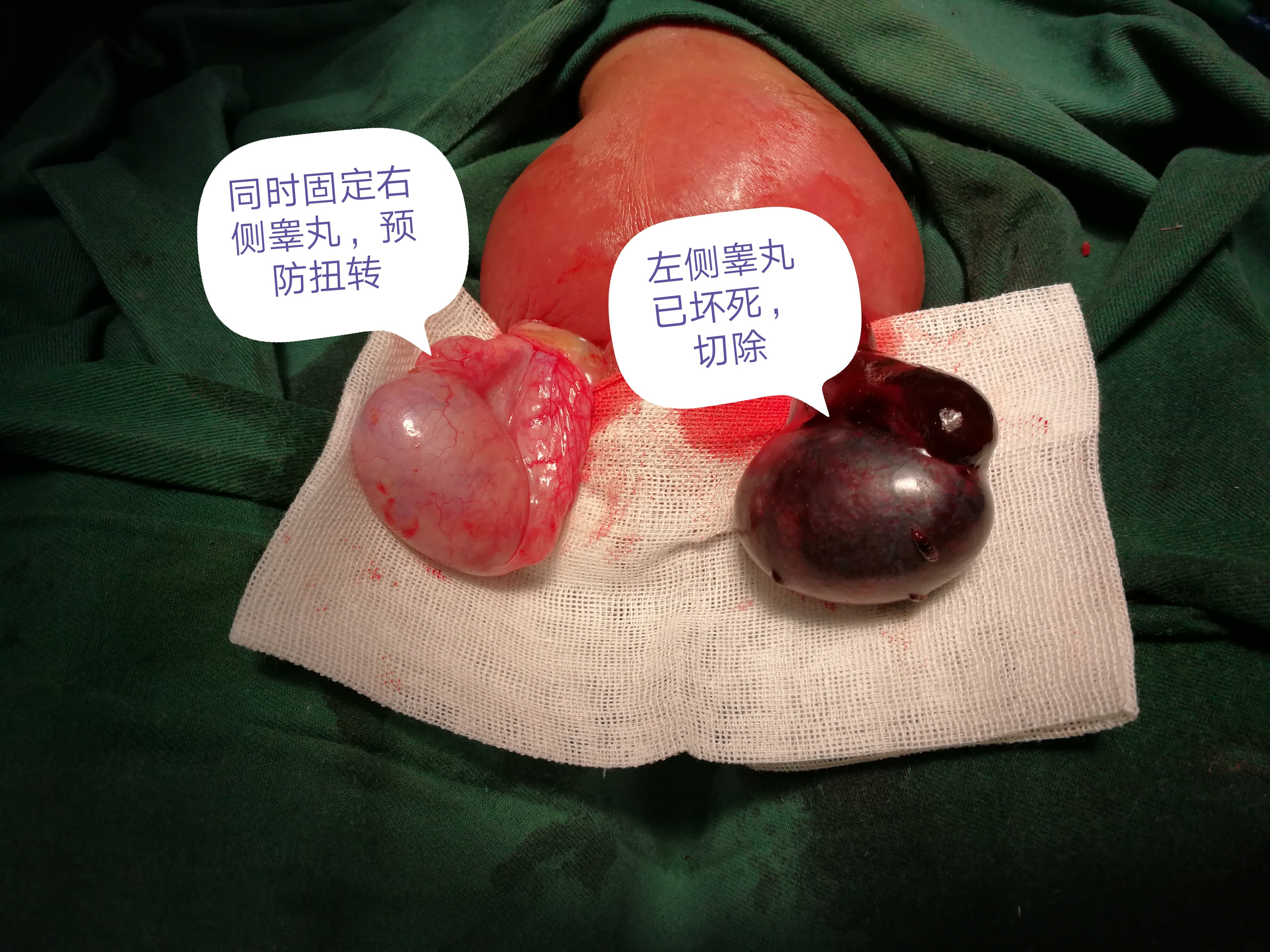 关注男孩睾丸健康 睾丸扭转 睾丸扭转 关注男孩睾丸健康 睾丸扭转 睾丸扭转
