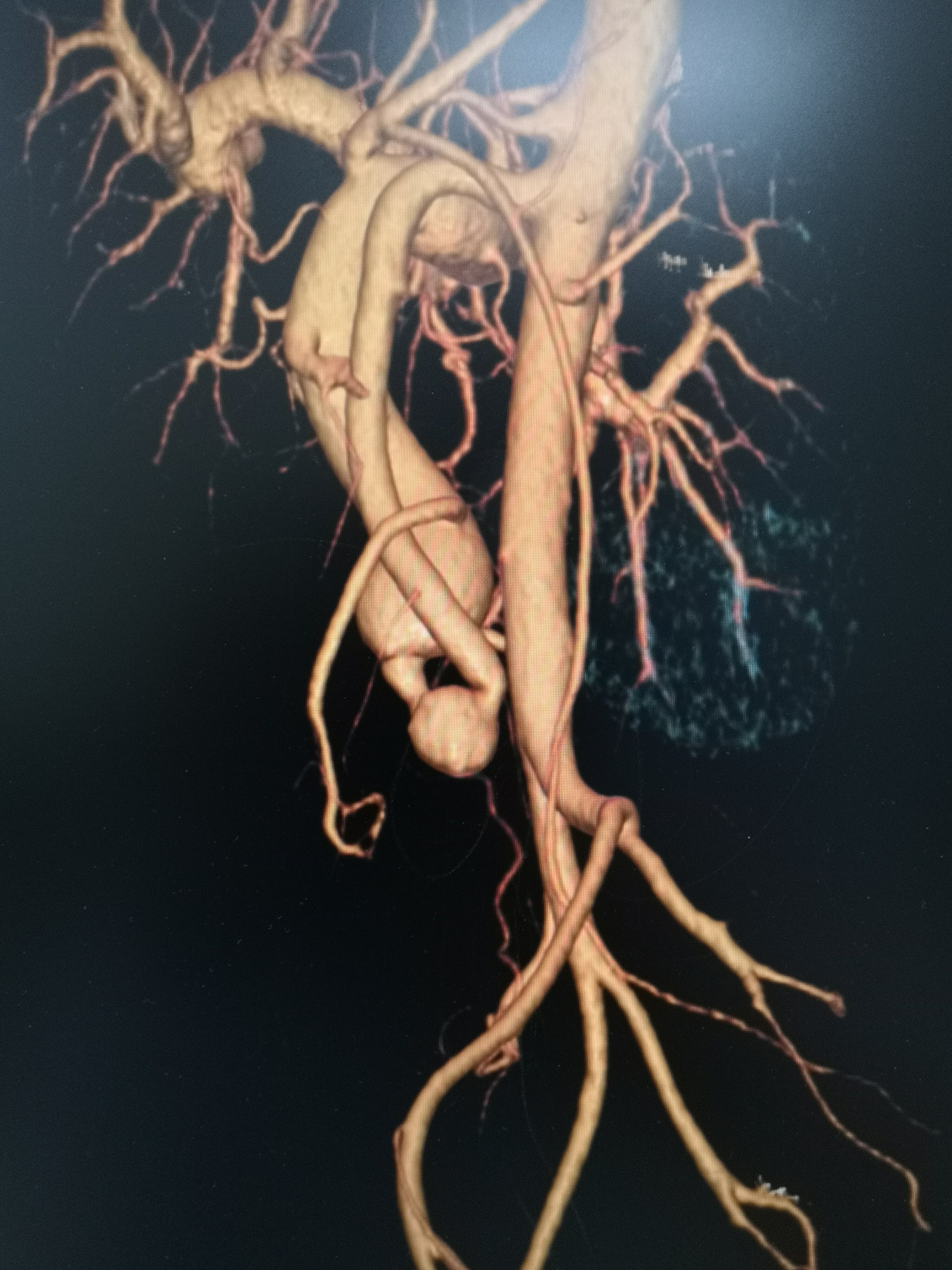 小肠血管畸形图片
