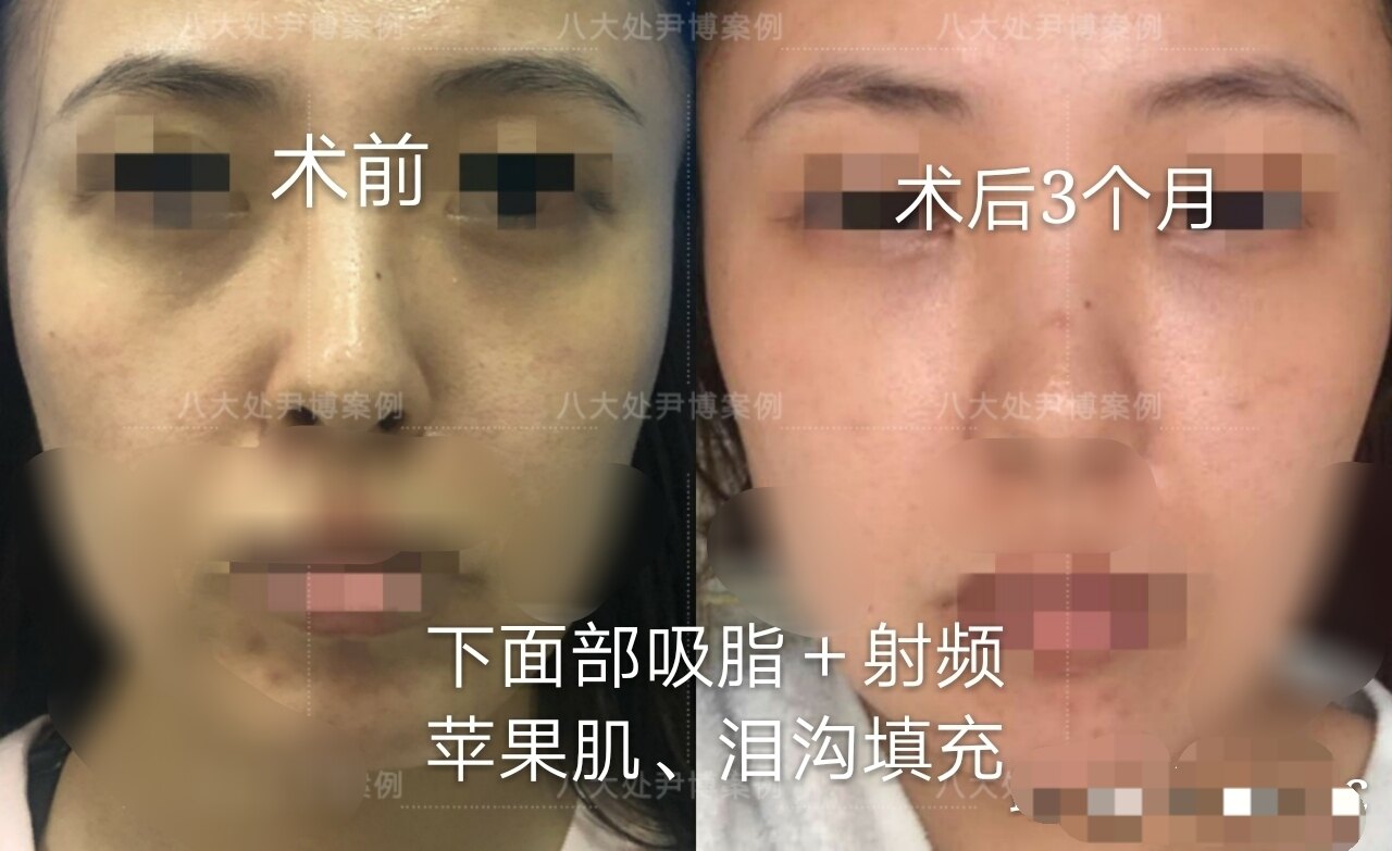 醫美 我要擁有蘋果肌 消除淚溝打造甜美princess公主風 星采醫美診所 古亭 玻尿酸醫美療程初體驗 保鮮美人部落格