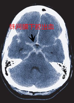 动脉瘤性蛛网下腔出血_蛛网膜下腔出血_发病原因_症状表现_治疗方式