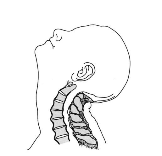 颈椎手术后出现颈肩部疼痛,僵硬的原因和处理办法