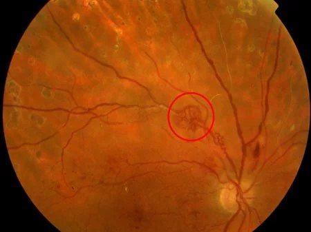 糖尿病眼底出血,黄斑水肿临床上根据是否出现视网膜新生血管为标志,将