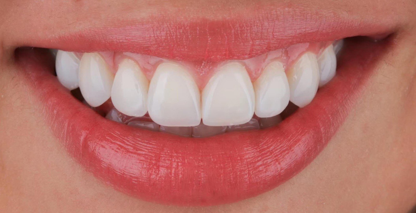 前牙美学修复关闭缝隙一例_牙颌畸形_牙颌畸形治疗方式 - 好大夫在线