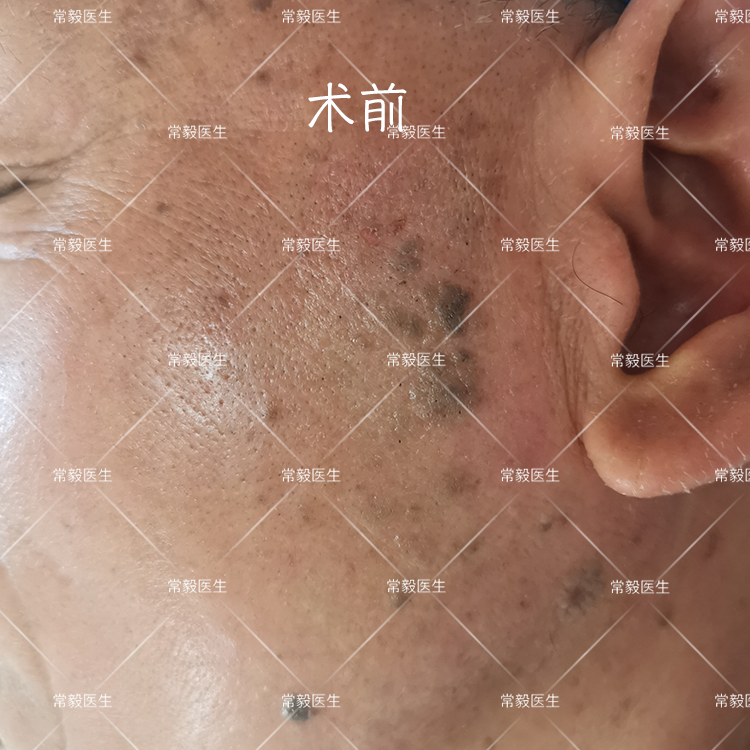 【co2激光治疗脂溢性角化(老年斑)个人案例分享】