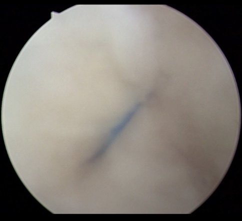 华医生科普之腕关节顽固疼痛之三角软骨盘(tfcc)损伤_关节损伤_关节