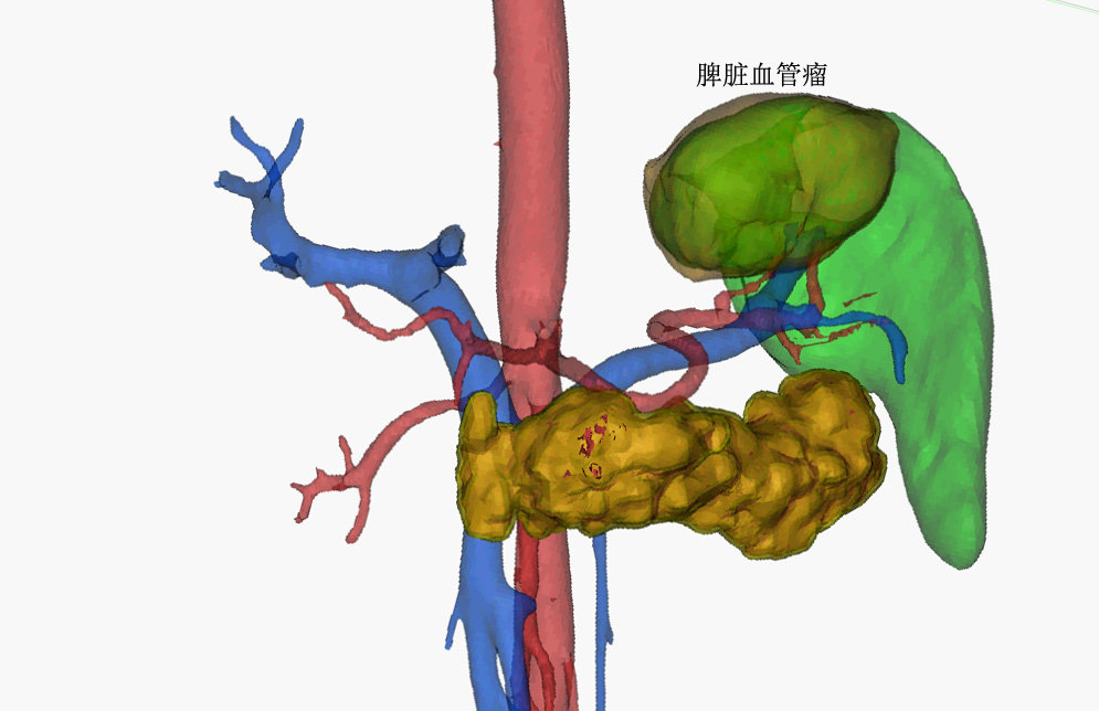 脾脏良性肿瘤或低度恶性肿瘤必须切除整个脾脏吗其实还可以选择保留