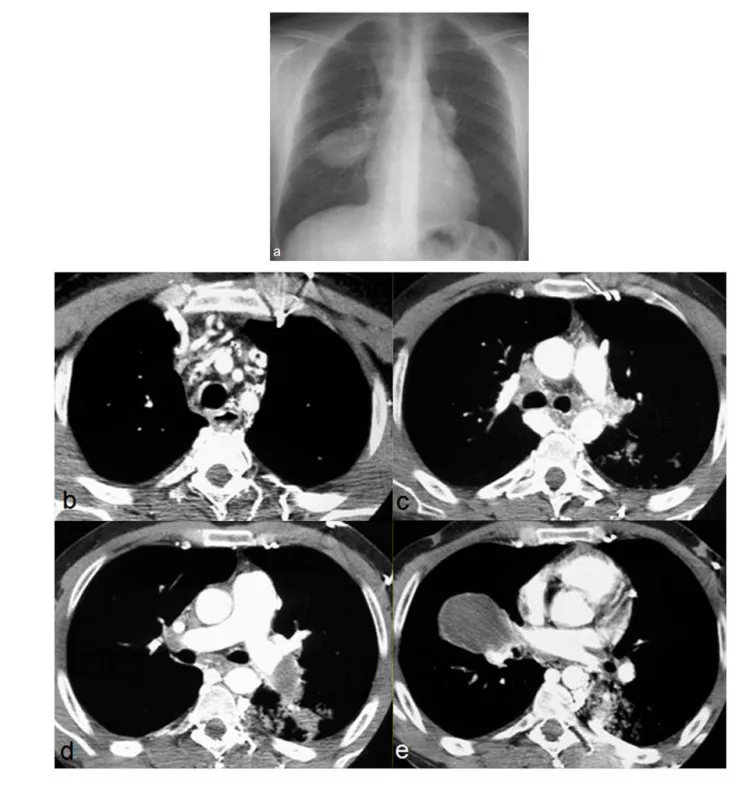 系统性血管炎的肺部影像学表现及鉴别诊断_血管炎_症状表现_检查 - 好