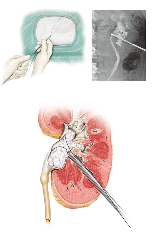 肾盂切开取石术图片