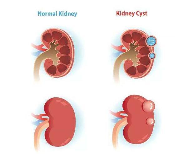 肾囊肿