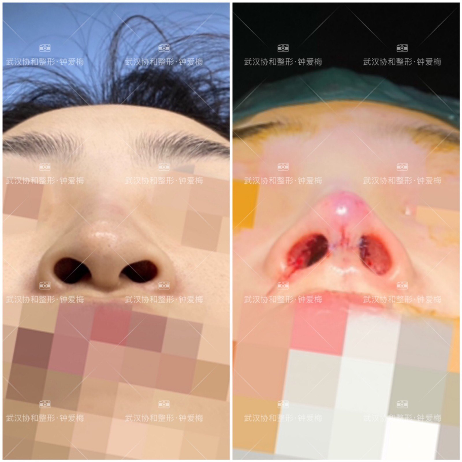 钟爱梅医生肋软骨鼻综合修复案例分享_鼻部整形_鼻部整