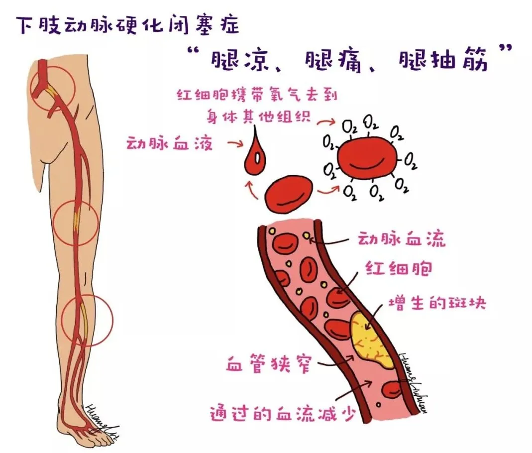 "走走停停,是双腿的呐喊_动脉硬化闭塞症_动脉硬化闭塞症症状表现