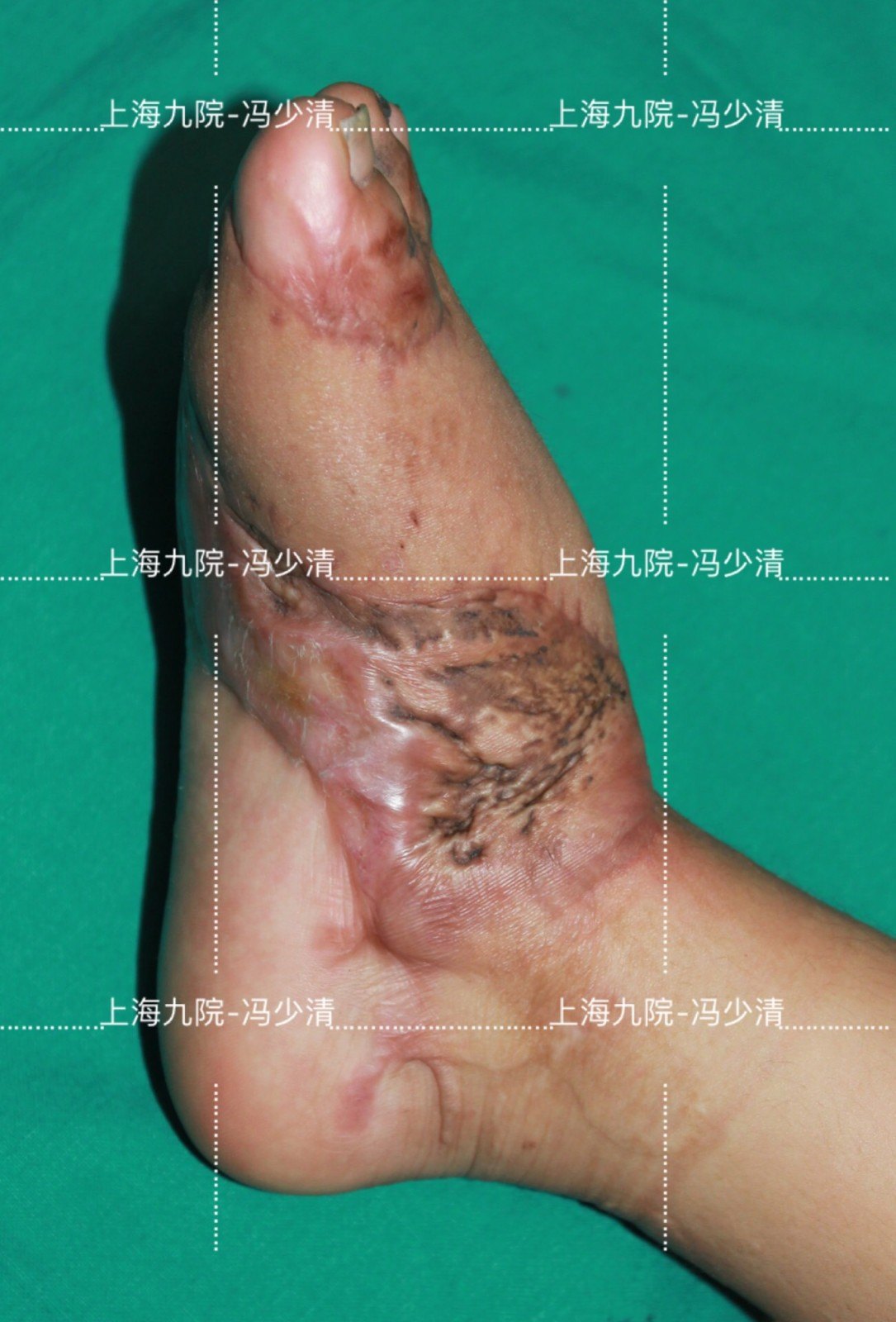 儿童烧烫伤后瘢痕挛缩畸形的皮瓣手术治疗