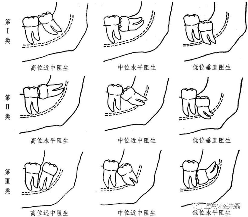 究竟什么是阻生智齿,需要拔除吗?_阻生齿_介绍_症状表现_治疗方式- 好大夫在线