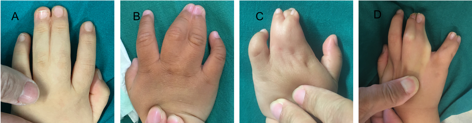 并指的治疗 先天性并指多指畸形 先天性并指多指畸形 并指的治疗 先天性并指多指畸形 先天性并指多指畸形