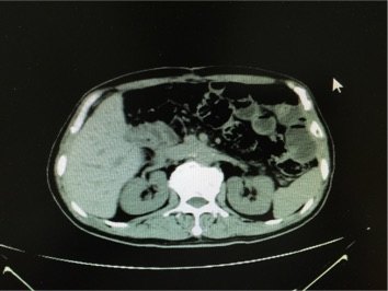 胰腺肿瘤的微创治疗3:腹腔镜下胰腺假性囊肿空