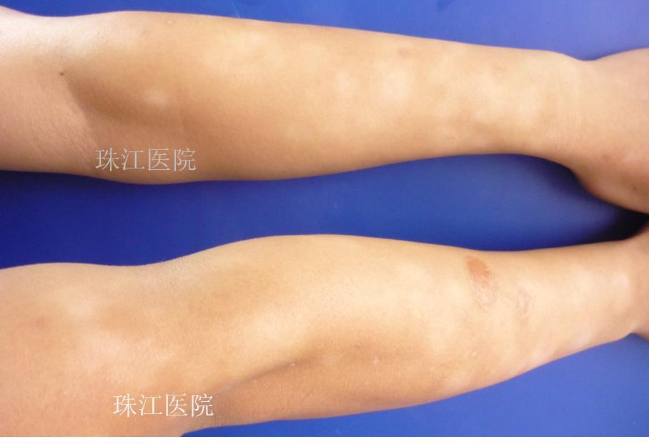 儿童皮肤出现白斑一定是白癜风吗?