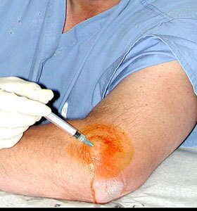 cortisone-shot-med.jpg
