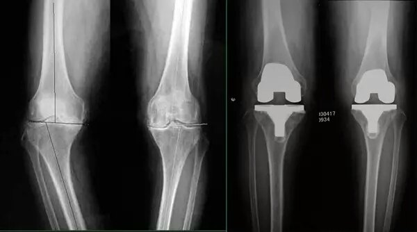 骨关节炎是什么