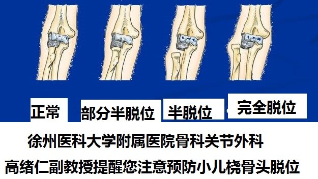 从徐州靓点舞校小美女肘关节不能活动谈小儿桡骨头半脱位