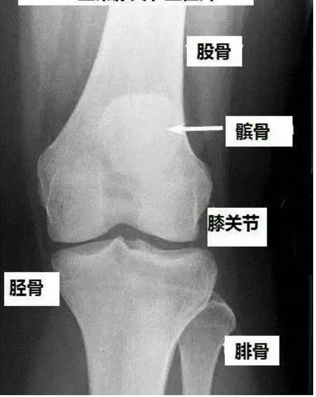 膝关节侧位片解剖图片