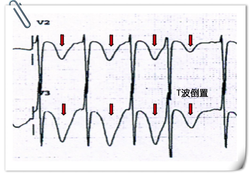 不同于急性st段心肌梗死,心电图(如下图)表现为st段压低和/或t波倒置