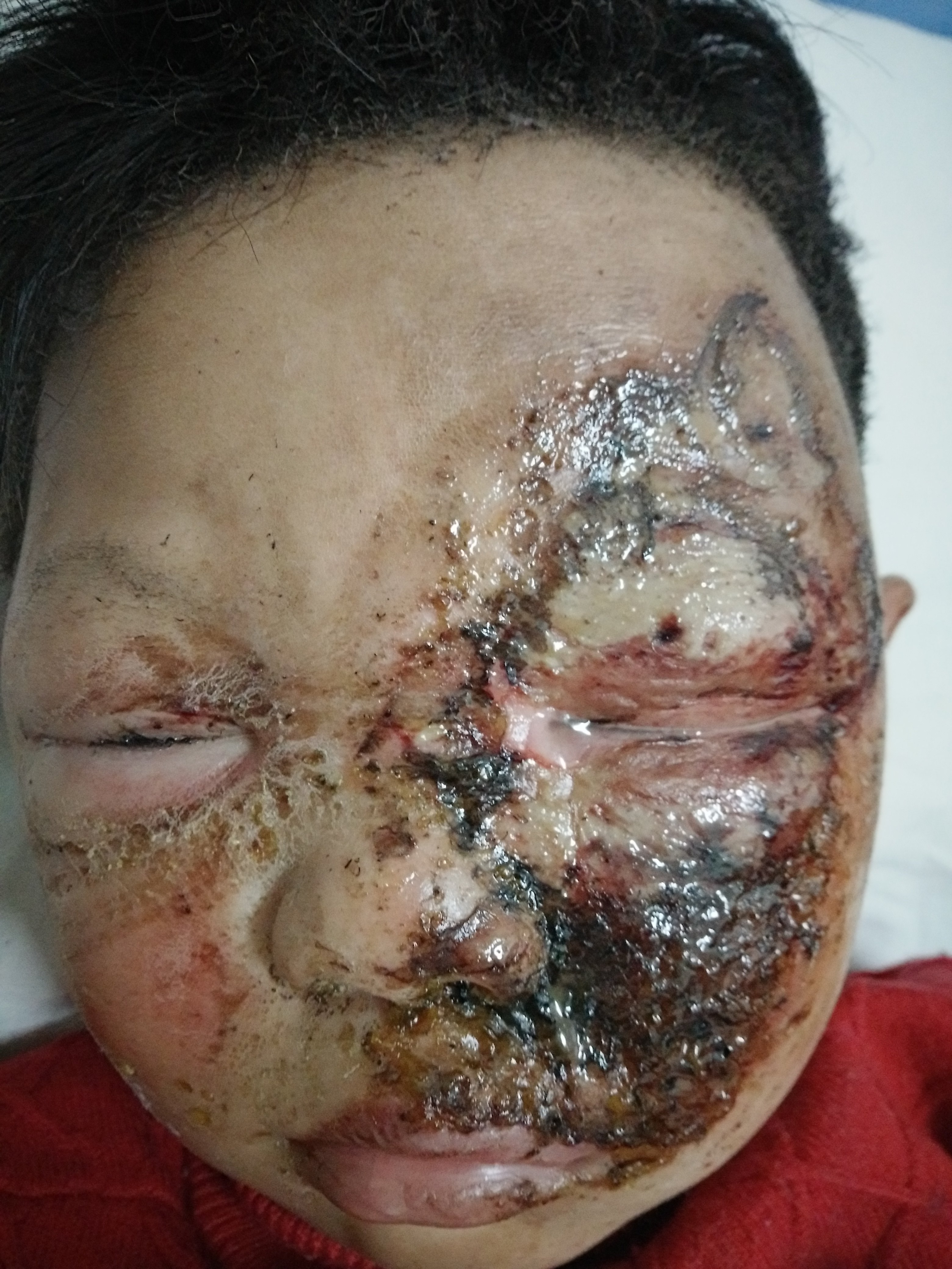 烫挑水泡消破油会起泡吗_油烫水泡不挑破会自己消吗_烫水泡挑破皮要去掉吗