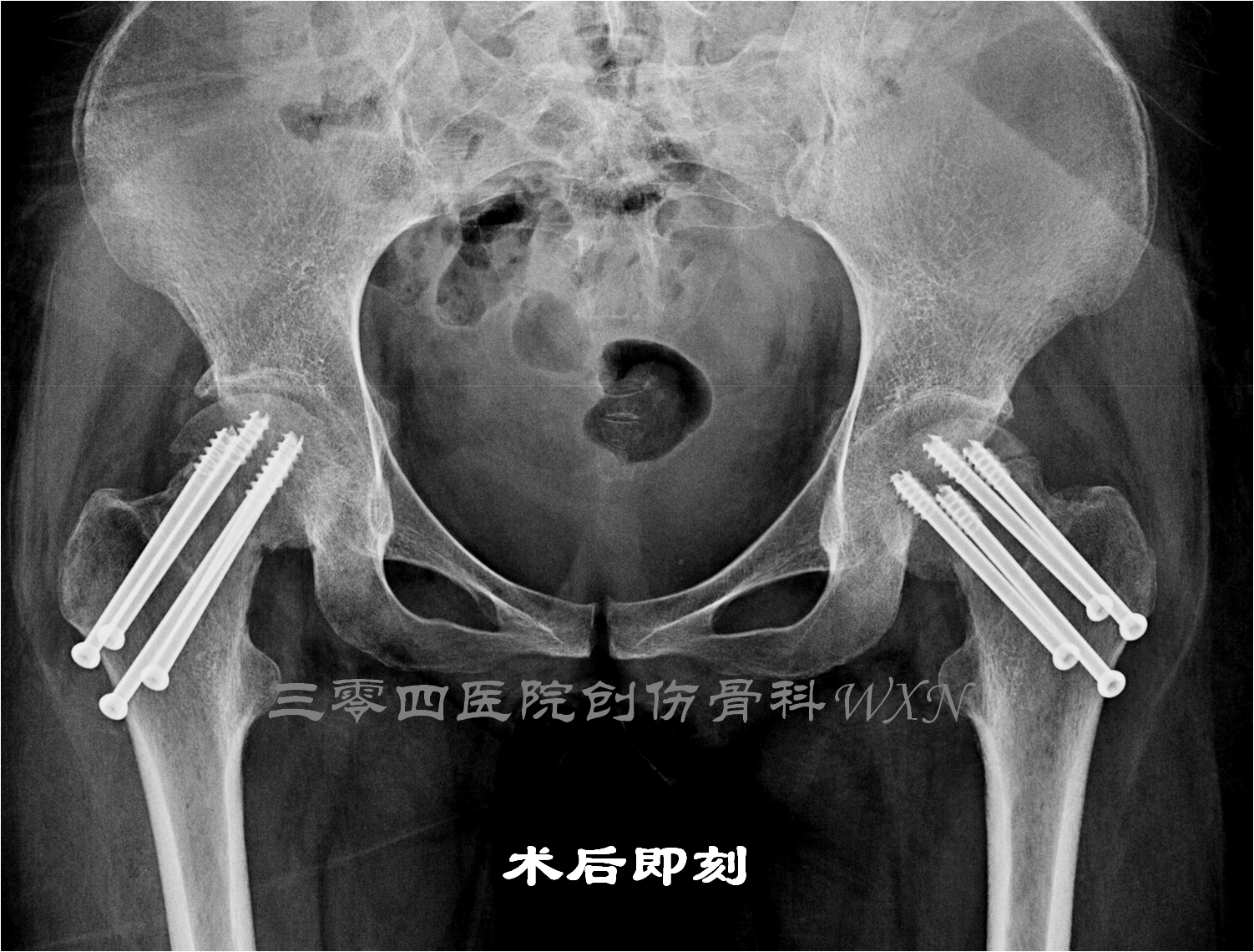 股骨颈骨折不愈合(罕见病例三):妊娠期双侧股骨颈骨折 - 好大夫在线
