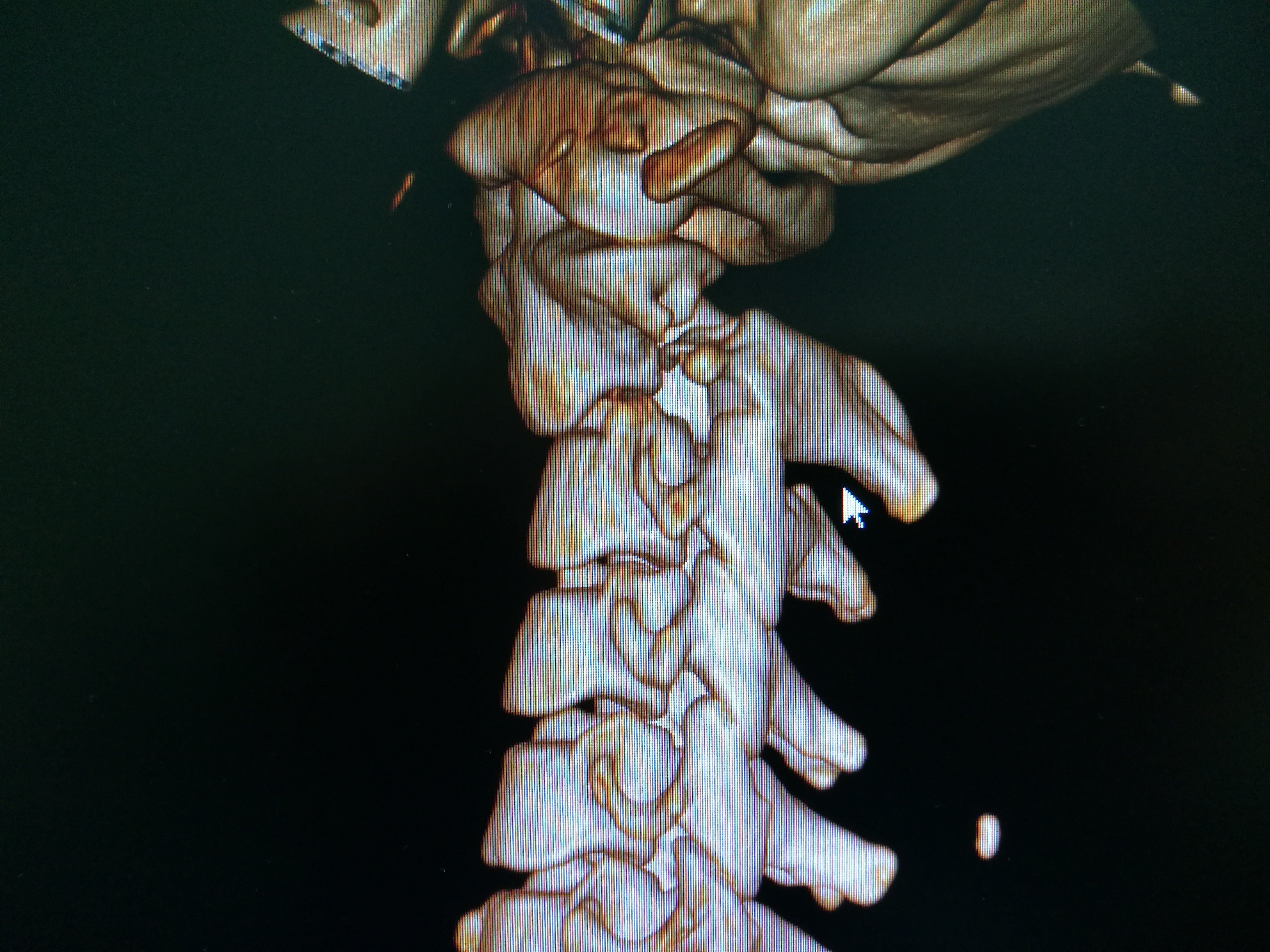 第2节颈椎椎弓骨折 