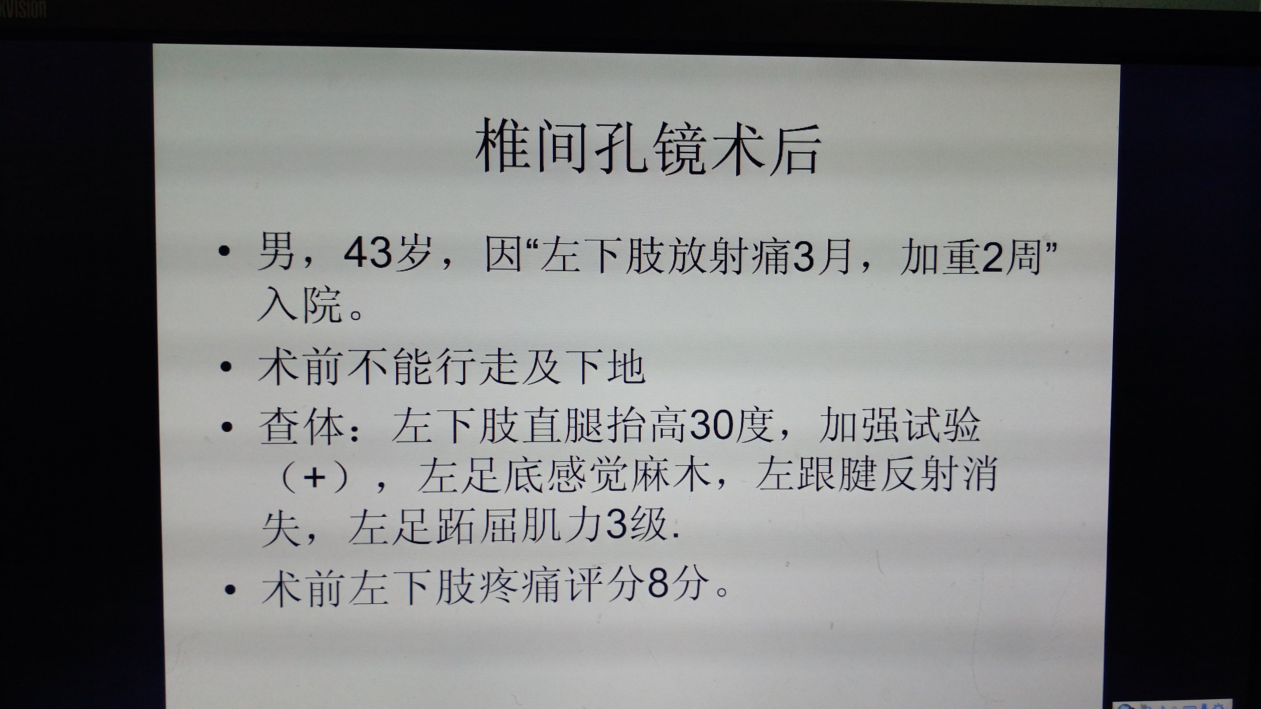 椎间孔镜手术病例41腰5骶1椎间盘游离髓核重度脱垂