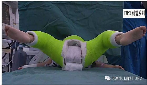 人类位石膏裤(human position spica cast)兼顾了复位后稳定性及头
