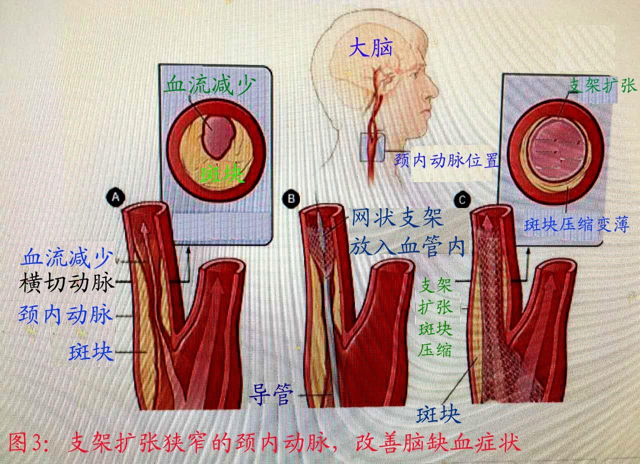 颈动脉斑块图片及说明图片