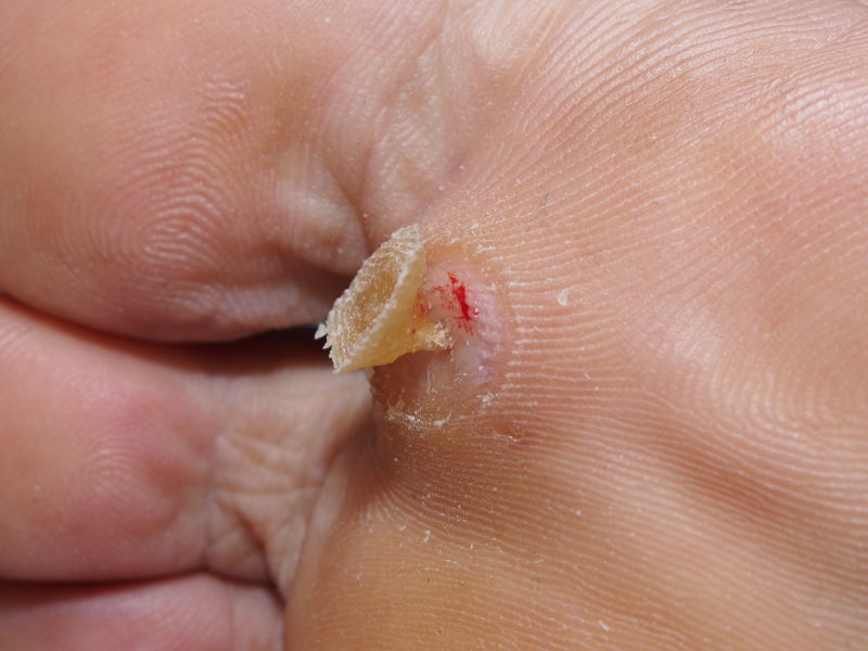 传统修脚……治疗鸡眼 - 好大夫在线