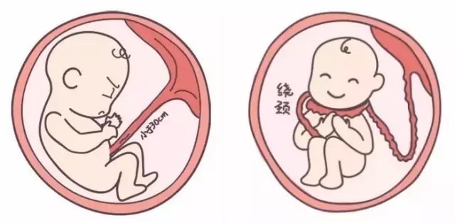 而脐带过长是指脐带长度超过100cm,脐带过长容易造成一系列危险,比如