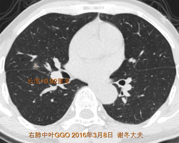 肺磨玻璃結節的生長速度如何會不會突然變成晚期肺癌