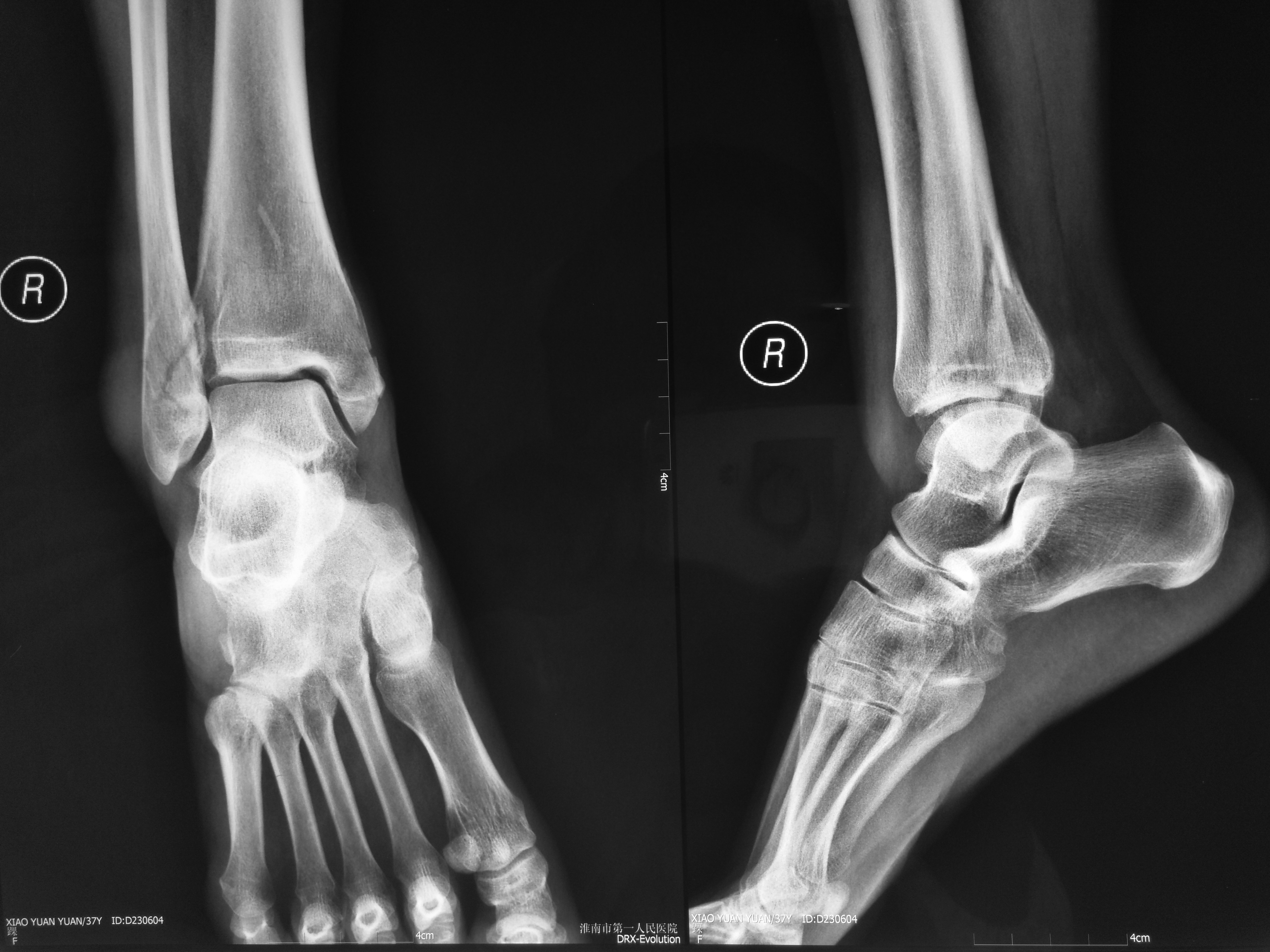 三踝骨折 - 好大夫在线