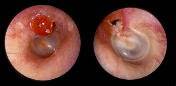 中耳炎系列科普五——胆脂瘤,耳朵里的破坏大王