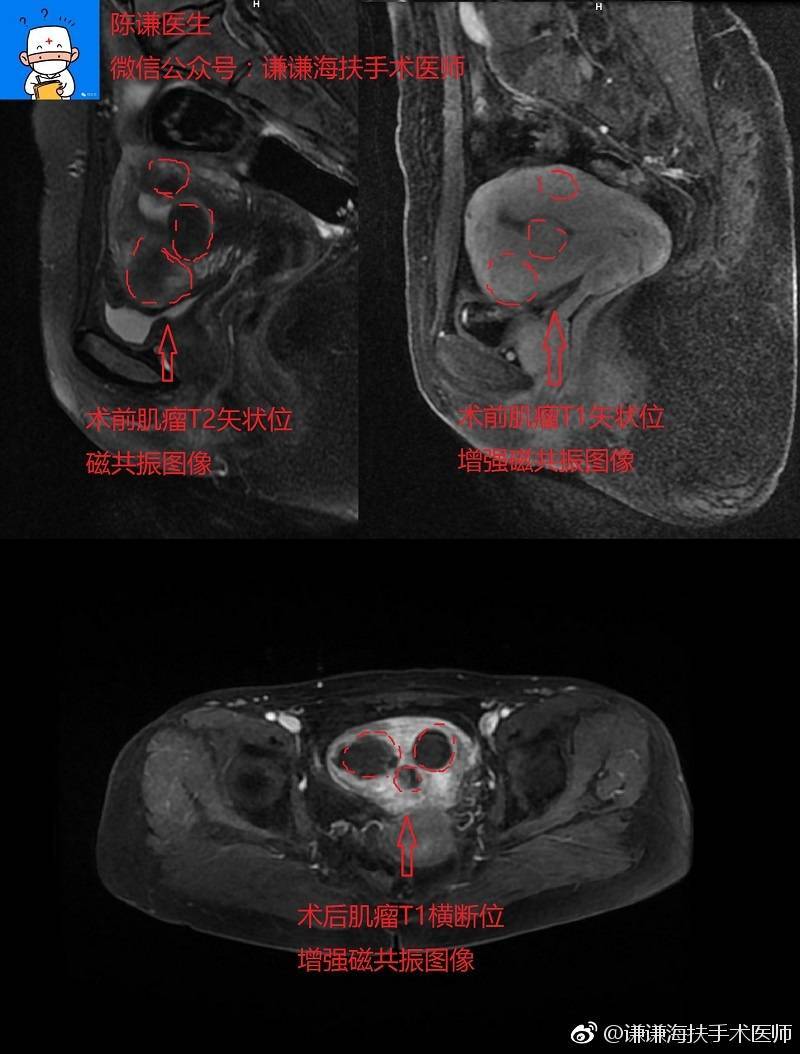 周某某子宫肌瘤海扶刀手术病例分享
