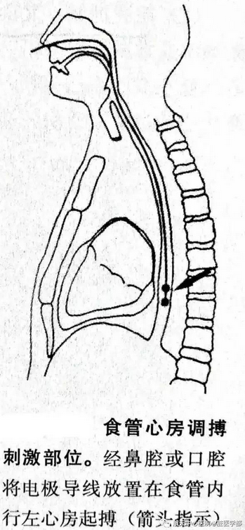 食道调搏图片
